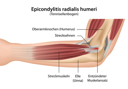 Epikondylitis humeri radialis (Tennisellenbogen)