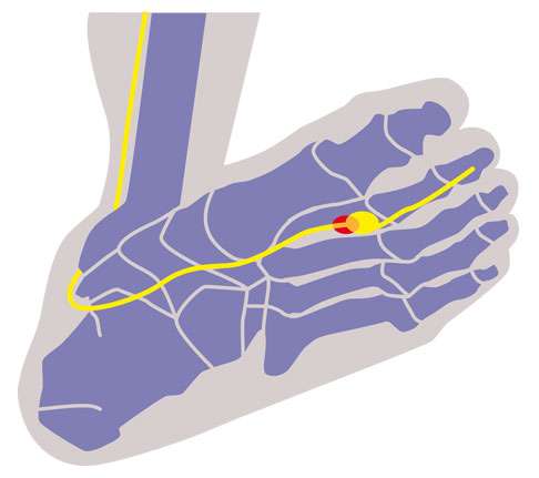 Sicht von der Fußsohle aus auf ein Morton Neurom (rot)