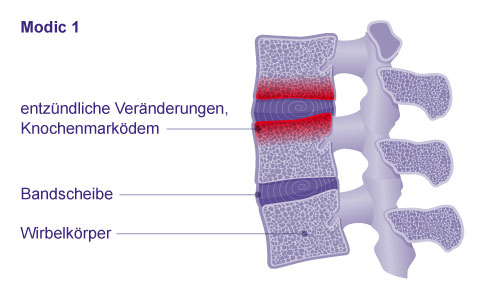 Klassifikation der Osteochondrose intervertebralis: Modic Typ 1