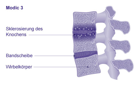 Klassifikation der Osteochondrose intervertebralis: Modic Typ 3