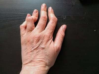 Arthritis deutlich zu erkennende Handgelenkdeformierung