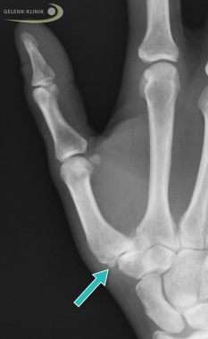 Röntgenbild einer Daumensattelgelenkarthrose mit Osteophyten