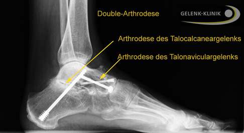 Röntgenbild des Fußes mit Doublearthrodese