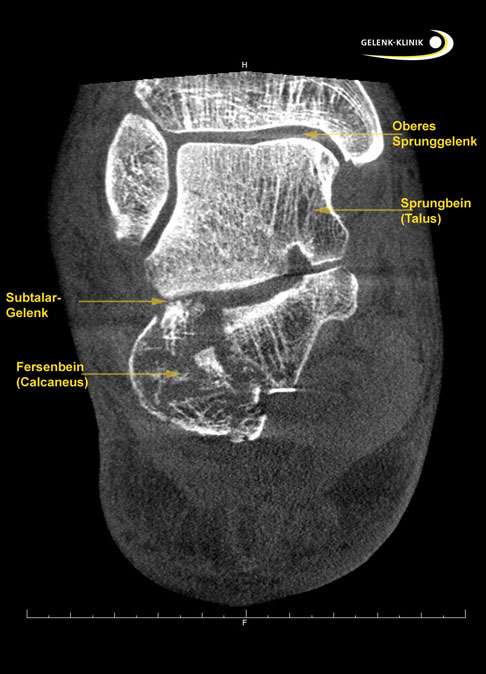Komplexe Fraktur des Fersenbeins in einer SPECT-CT-Aufnahme
