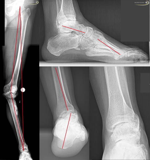 Röntgenbilder von Fuß- und Kniefehlstellungen aufgrund von Charcot-Marie-Tooth