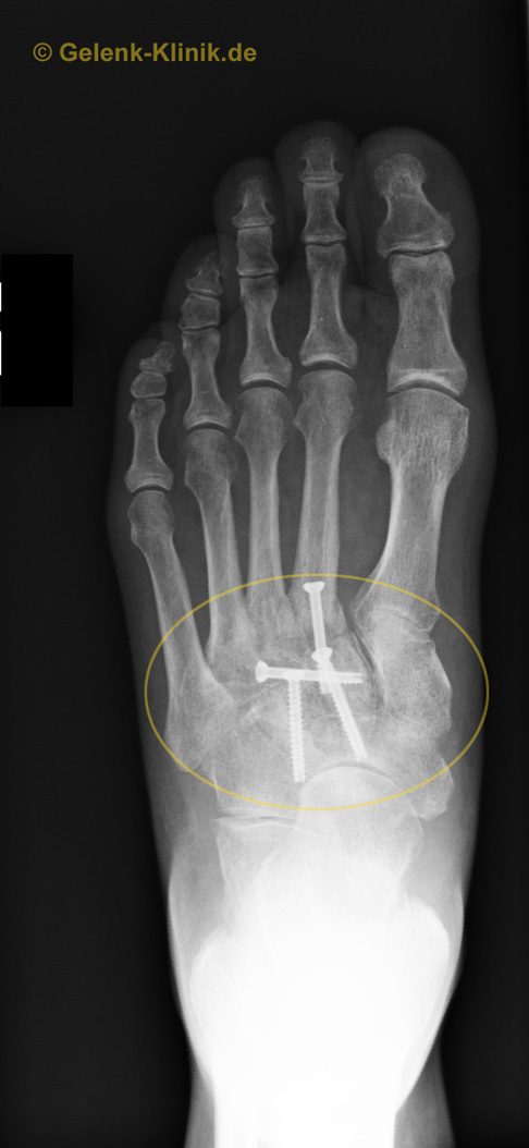 Versteifung (Arthrodese) der Fußgelenke (Fußwurzelgelenke) nach Arthrose