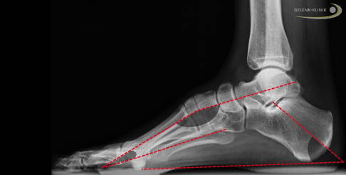 Röntgenbild eines Ballenhohlfußes mit eingezeichneten Knochenachsen