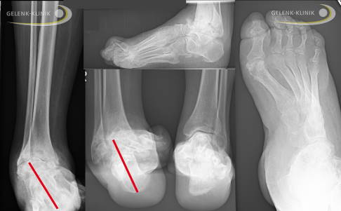 schwere Fußfehlstellung im Röntgenbild