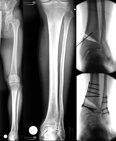 Röntgenbild: Behandlung einer Sprunggelenksarthrose durch Begradigung des Talus (Sprungbein).
