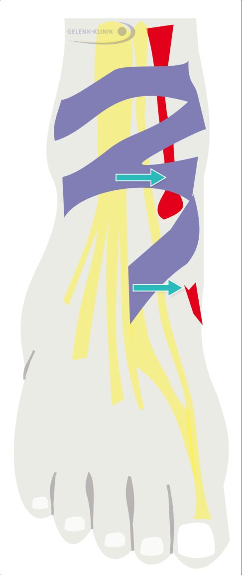Ruptur der Tibialis-anterior-Sehne