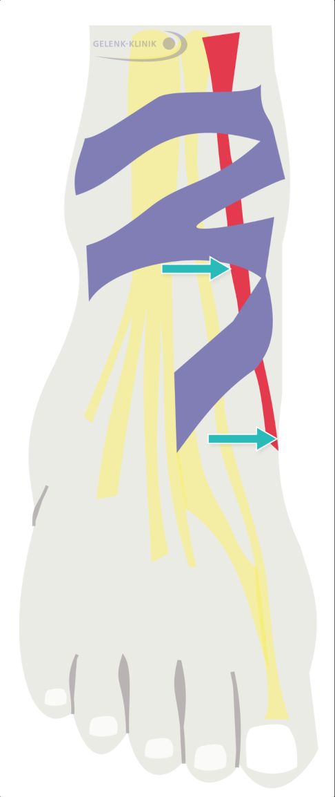 typische Lage der Tibialis-anterior-Sehne