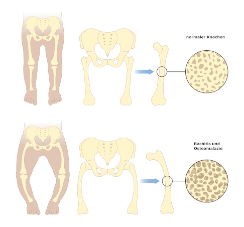Gegenüberstellung Osteomalazie und gesunder Knochen