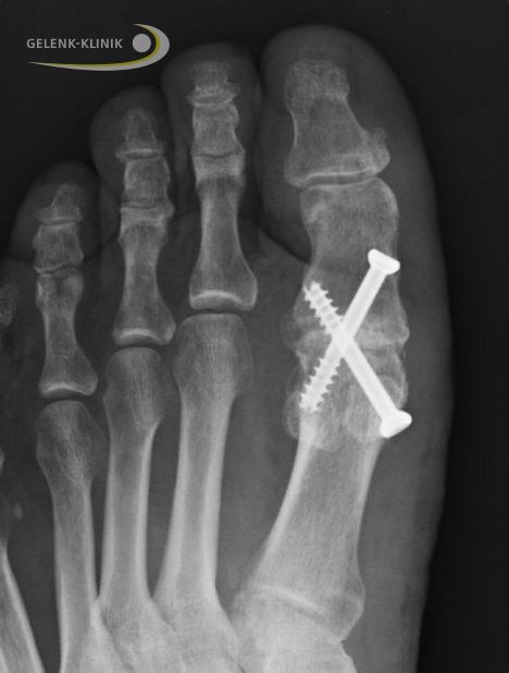 Röntgenbild einer Arthrodese