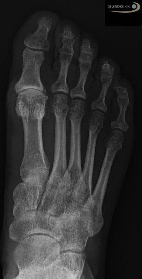Röntgenbild: Arthrose des Großzehengelenks