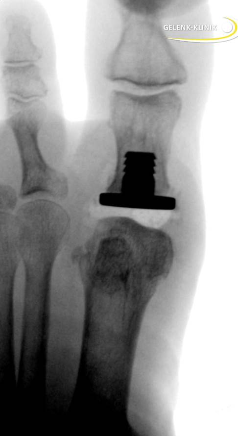 Röntgenbild einer Hemiprothese bei Hallux rigidus