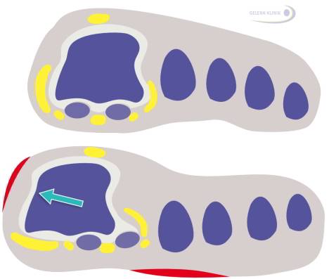 Druckstellen an der Fußsohle der kleinen Mittelfußknochen durch veränderte Belastung der 2. bis 4. Zehen