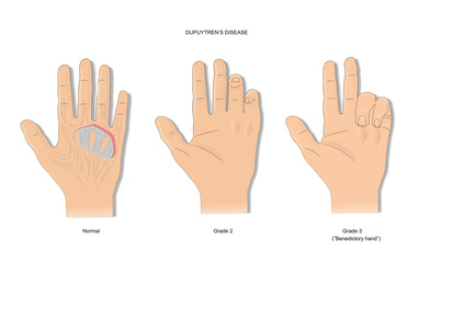 Morbus Dupuytren im Vergleich zur gesunden Hand