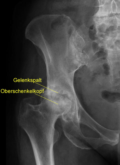 Röntgenbild einer Coxarthrose