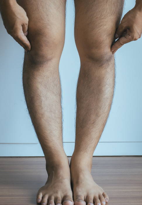 Mann mit O-Beinen