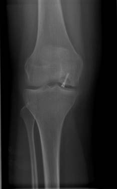 Röntgenaufnahme Refixation eines abgelösten Knorpel-Knochen-Fragments