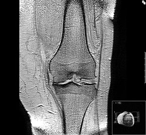 MRT-Bild einer Kniearthrose mit deutlich verschmälertem Gelenkspalt