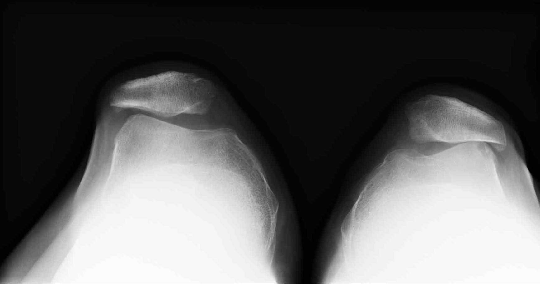 Пателлофеморальный артроз, рентген: На данном снимке пациент лежит на спине, ноги согнуты в коленях. Снимок показывает состояние суставной щели при двух феморопателлярных суставах. Слева видно удовлетворительное состояние суставной щели. Коленная чашечка (надколенник) и надколенниковая поверхность бедренной кости находятся на расстоянии боле 3 мм. друг от друга. Справа виден пателлофеморальный артроз: Надколенник и бедренная кость касаются друг друга, хрящевой слой полностью изношен.© Gelenk-Klinik.de