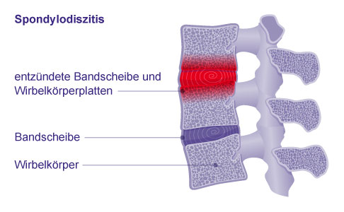 Grafik: Spondylodiszitis mit entzündeter Bandscheibe und Wirbelkörperplatten