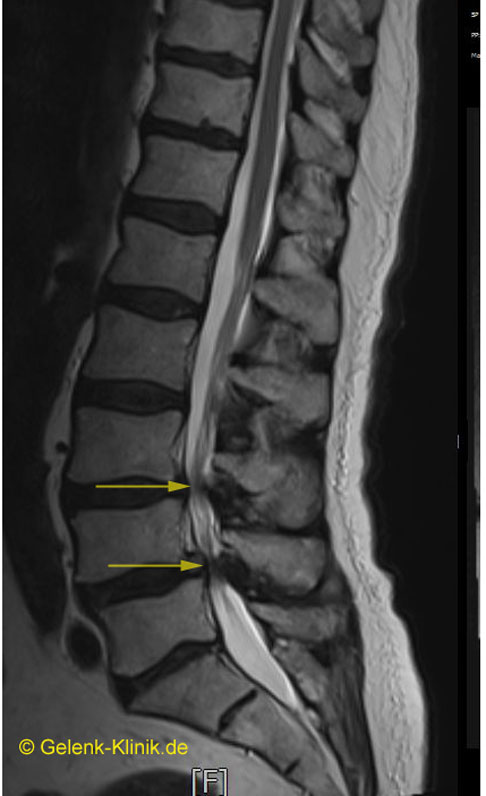 Wirbelkanalstenose Spinalstenose Verengung Des R Ckenmarks F Hrt Zu