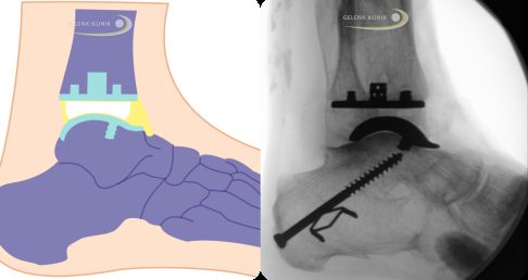 Schema und Röntgenaufnahme einer Sprunggelenksprothese der 5. Generation.