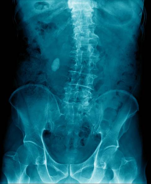 Röntgenbild einer Wirbelsäule mit Skoliose