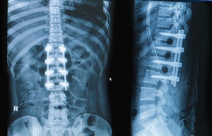 Röntgenbild: Versteifung der Lendenwirbelsäule