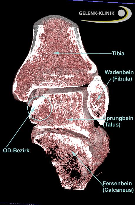 Osteochondrosis dissecans im Sprunggelenk