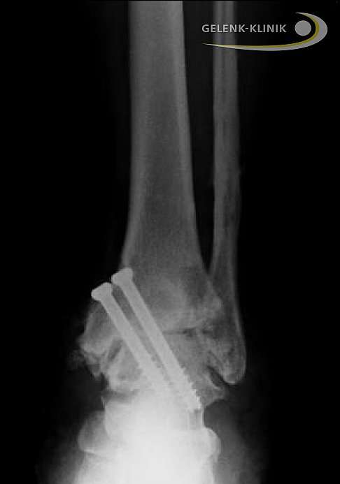 Arthrodese Sprunggelenk Röntgenbild von vorne