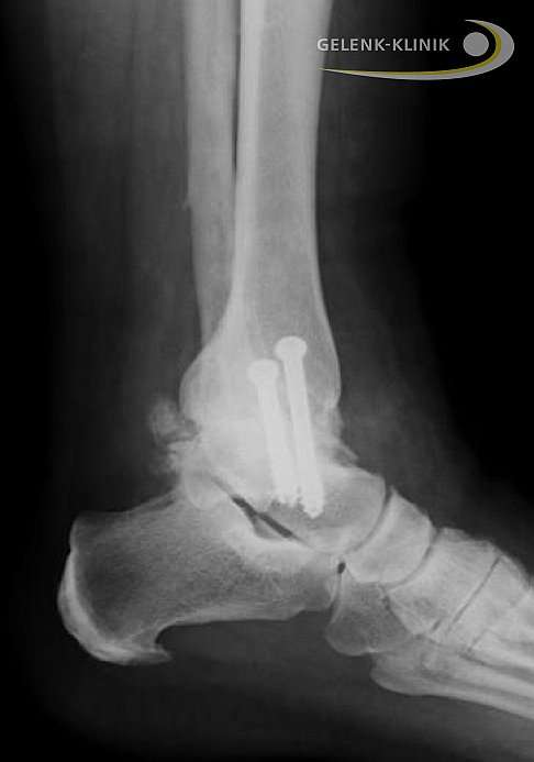 Arthrodese im Sprunggelenk