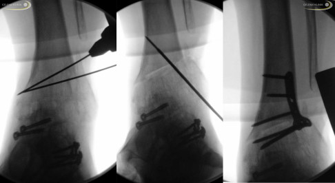 Fehlstellung nach Versteifung, Osteotomie