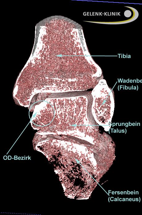 Digitale Volumentomographie: Osteochondrosis dissecans im Sprunggelenk