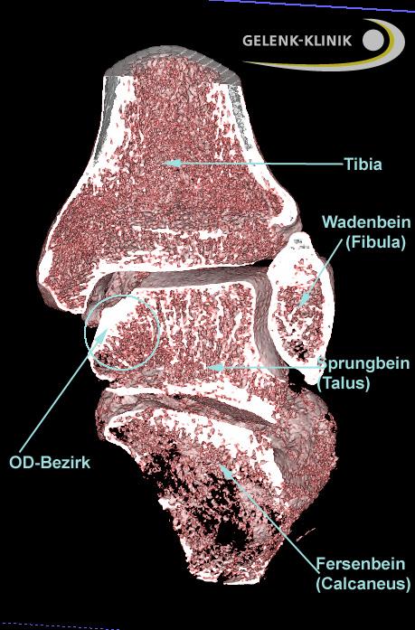 Ansicht des Sprunggelenks von hinten in der 3-D digitalen Volumentomografie (DVT): Von oben kommen Schienbein (Tibia, links) und Wadenbein (Fibula, rechts) und bilden gemeinsam die Sprunggelenksgabel. Der fußseitige Gelenkpartner, der das gesamte Körpergewicht aufnimmt, ist das Sprungbein (Talus). Eine Osteochondrosis dissecans des Sprunggelenks bildet sich immer am Talus aus. Meistens sind, wie hier, die konvexen Ränder des Talus von der OD betroffen. © Gelenk-Klinik Osteochondrosis dissecans im Sprunggelenk