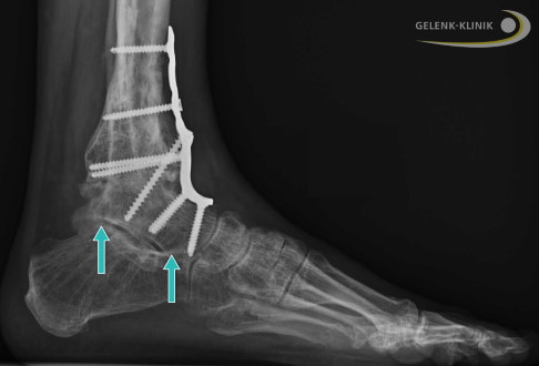 Begleitarthrose im Sprunggelenk nach Arthrodese