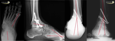 Fehlstellung im Sprunggelenk nach Arthrodese