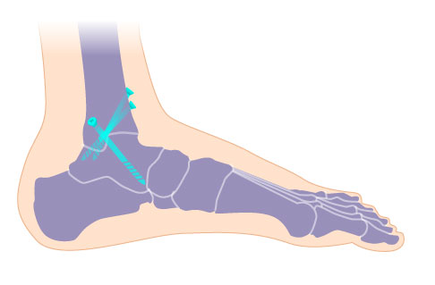 Schematische Darstellung einer Arthrodese im Sprunggelenk