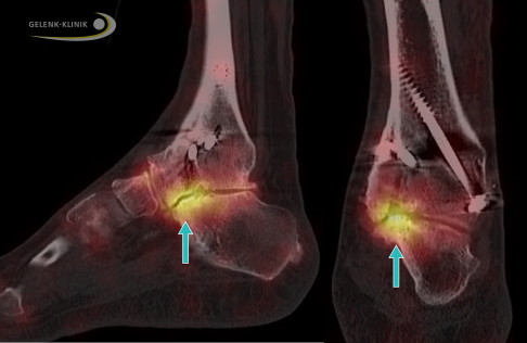 SPECT vom Fuß nach Arthrodese des OSG