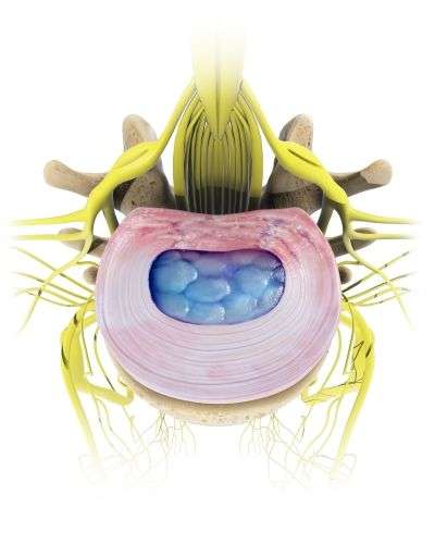 Bandscheibenvorfall: Symptome und Behandlung der ...