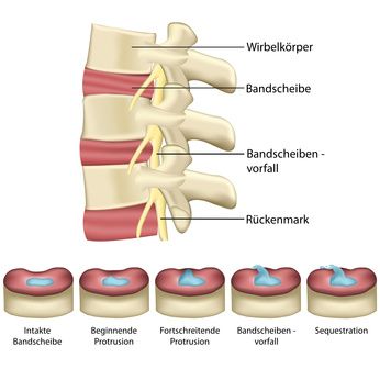 Если прочная оболочка (Anulus fibrosus) прогибается под давлением пульпозного ядра, возникает протрузия межпозвоночного диска. По этой причине может развиться грыжа. 