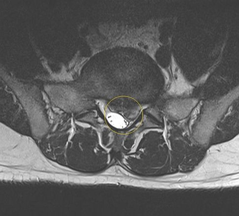 Bandscheibenvorfall: Ursachen, Diagnose, Therapie | Gelenk ...