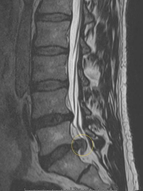 Bandscheibenvorfall Ursachen Diagnose Therapie Gelenk Klinik De