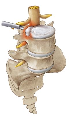 Minimalinvasive, endoskopische Bandscheibenoperation