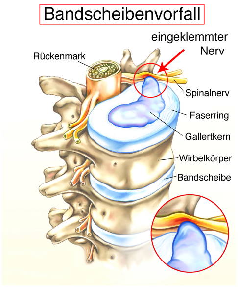 Schematische Darstellung eines Bandscheibenvorfalls