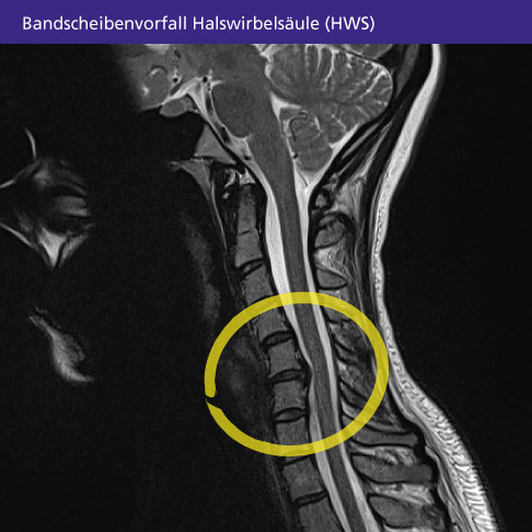 MRT eines Patienten mit Bandscheibenvorfall (Prolaps) der Halswirbelsäule (HWS). Der Vorfall liegt zwischen den Halswirbeln C5 und C6, daher wird der Bandscheibenvorfall mit HWS C5/C6 bezeichnet (gelber Kreis). © Gelenk-Klinik MRT eines Bandscheibenvorfalls der Halswirbelsäule.