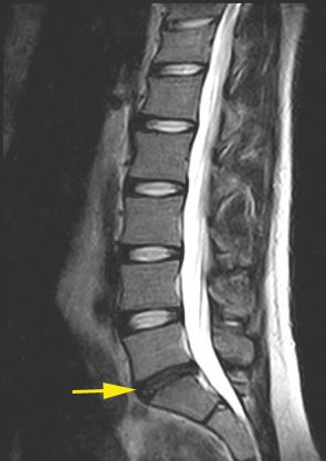 Bandscheibenvorfall Lwk 5 Swk 1 Therapie - Captions Hunter