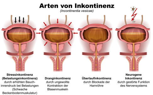 Arten von Inkontinenz: Man unterscheidet Stressinkontinenz, Dranginkontinenz, Überlaufinkontinenz und neurogene Inkontinenz.